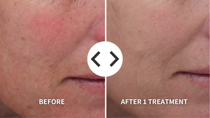 BBL Laser vs Other Treatments e1758172378792