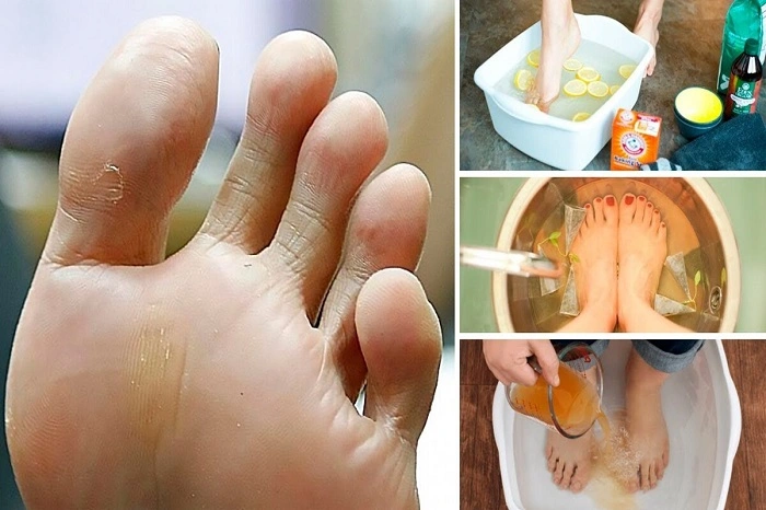 Causes of Smelly Feet 1