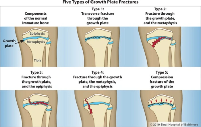 Growth Plate Injuries