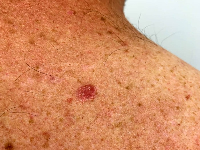 Lump Treatments and Healing Paths