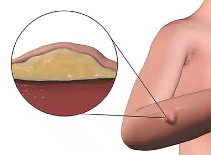 Symptoms That Travel with a Lump