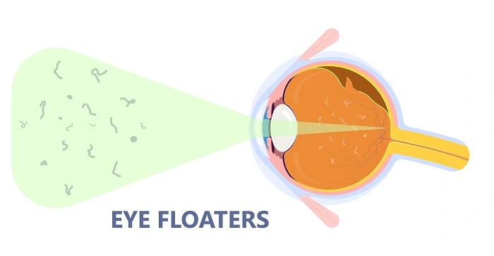 What Are Eye Flashes