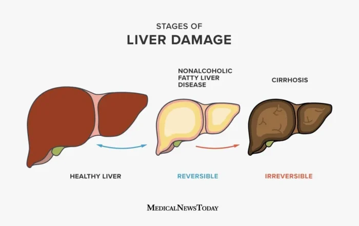 What is Hepatic Steatosis e1758173414470